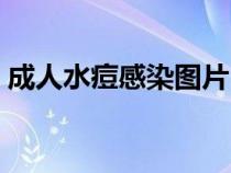 成人水痘感染图片（大人感染水痘初期图片）