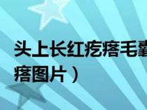 头上长红疙瘩毛囊炎怎么治疗（头皮上长红疙瘩图片）
