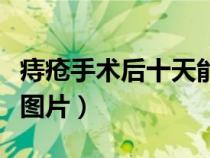 痔疮手术后十天能痊愈吗（痔疮手术十天恢复图片）