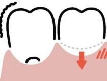 研究表明软牙龈更容易发炎