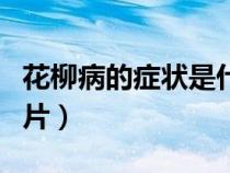 花柳病的症状是什么症状图片（花柳病症状图片）
