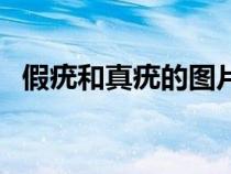 假疣和真疣的图片对比（脚上长跖疣图片）