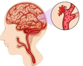 药物脑出血中风稀释副作用减轻有望患者血液研究