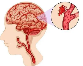 新钻研表明药物有望减轻血液稀释药物对于脑出血中风患者的副熏染